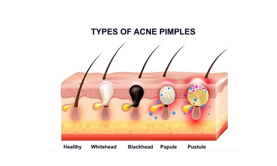 紅光療法對痤瘡的改善