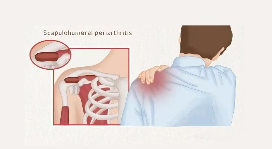 紅光療法對緩解辦公室人群痛症的作用