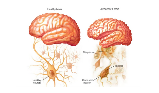 紅光療法 (RLT) 與阿爾茨海默的作用