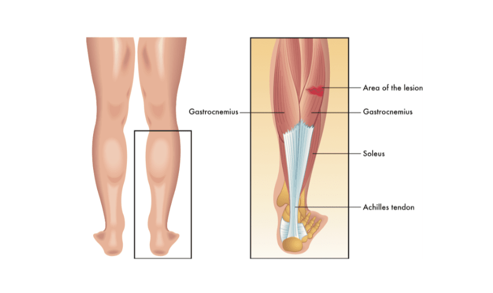 光生物調節在運動員創傷恢復中的作用