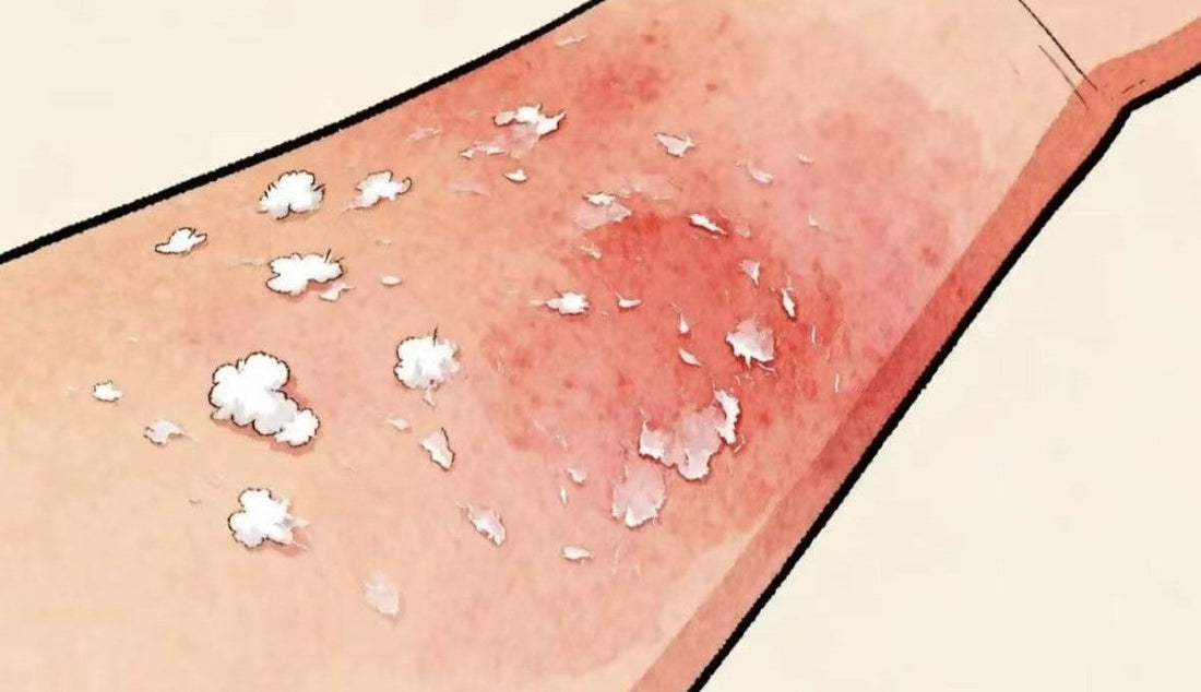 紅光療法對銀屑病（牛皮癬）的影響